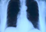 В Югре за предыдущий год выявлено 506 случаев туберкулеза