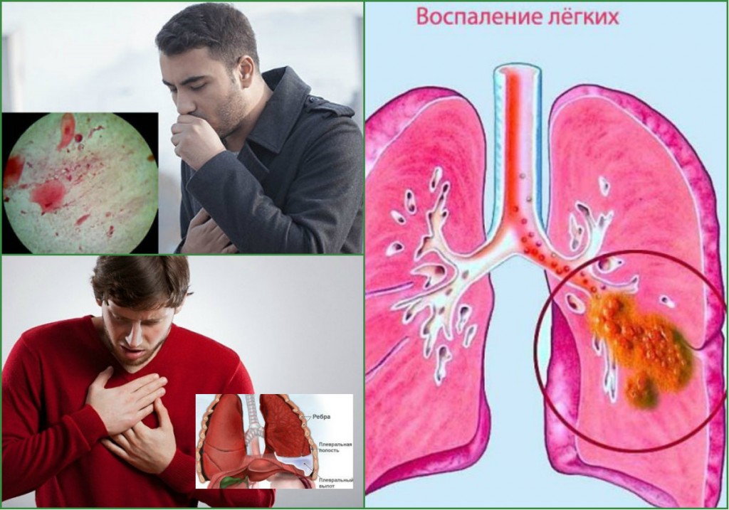 Внебольничная пневмония информация для родителей thumbnail