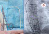 В Югре хирурги извлекли 12-сантиметровый катетер из сердца пациентки