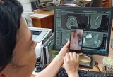 Няганские врачи удалили огромную остеому челюсти 74-летней пациентке